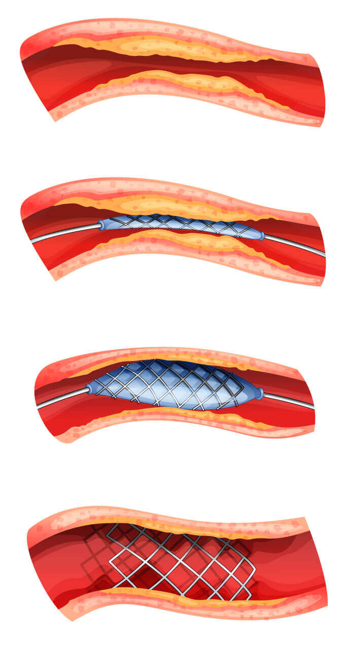 Illustration die das Einsetzen eines Stent in die Arterie zeigt. Der Stent wird mit einem Ballon eingeführt, die Arterie expandiert und der Stent gesichert.