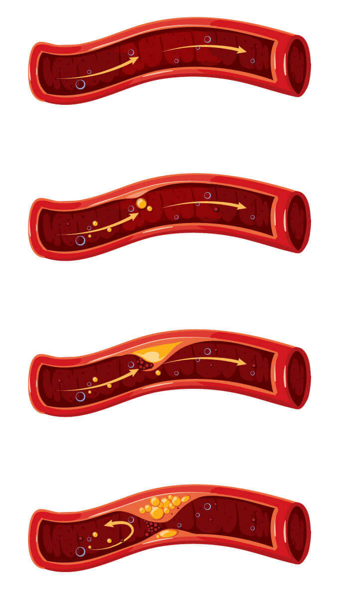 In der Illustration wird eine Arterien in den verschiedenen Stadien der Arterienverkalkung veranschaulicht. Früherkennung durch ein Kardio-CT kann diese Krankheit verhindern oder mildern.